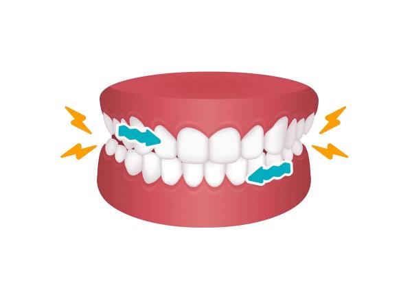 Могут ли болеть зубы от стресса? Как стресс влияет на зубы
